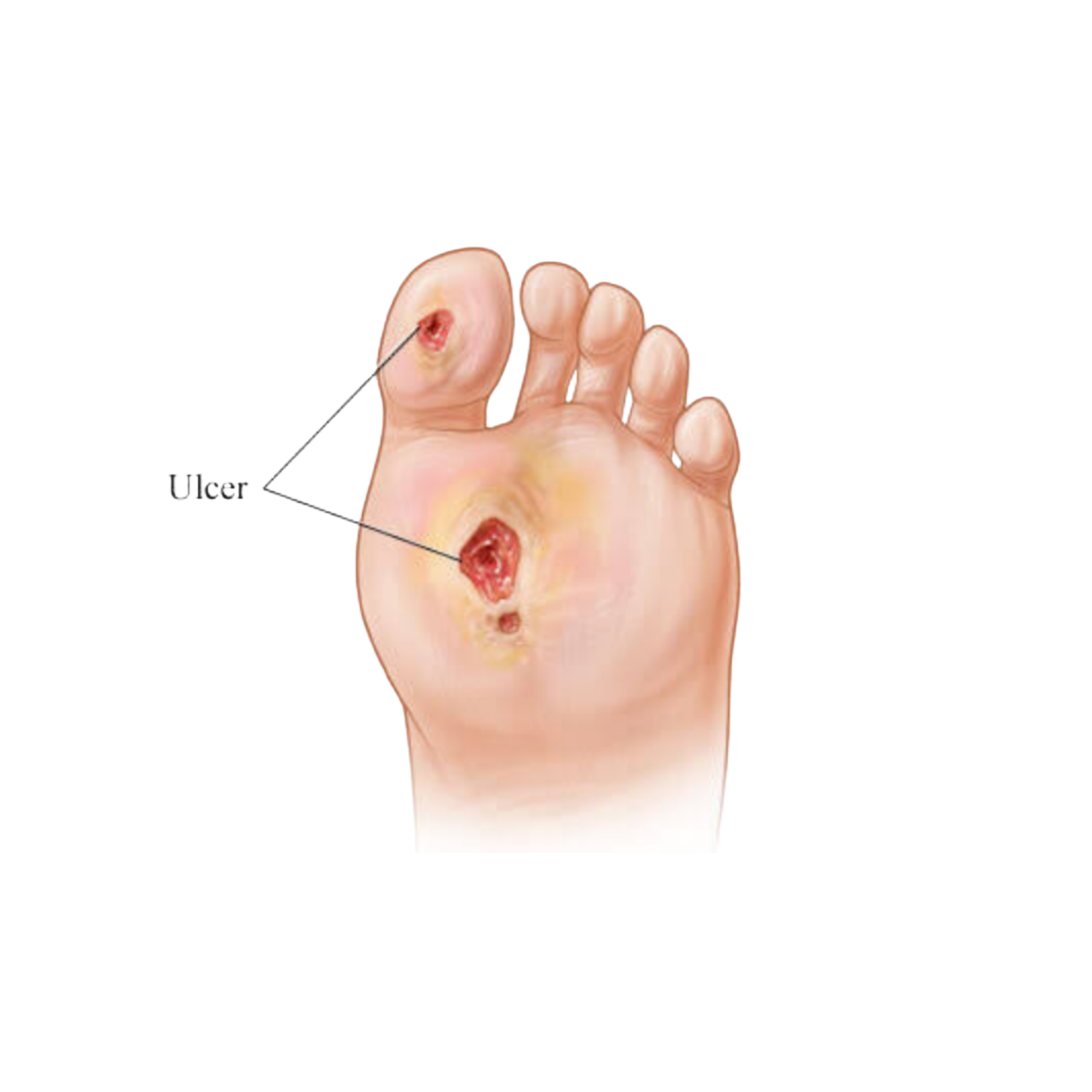 DIABETIC-WOUND-Pothigai-Health-Care